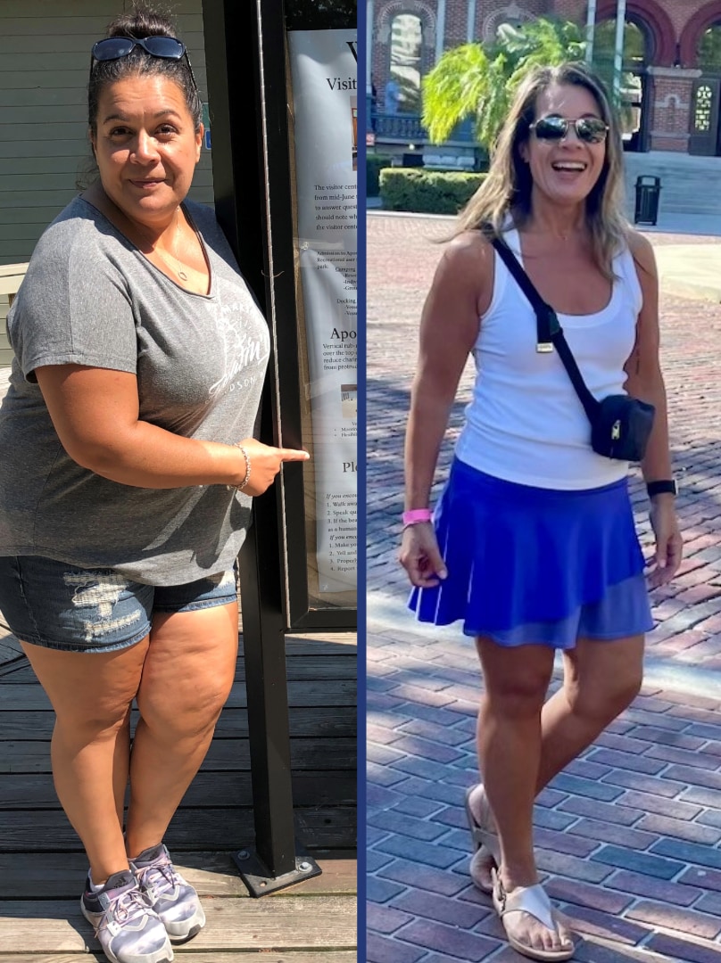 Mary Dillerud bariatric patient before and after